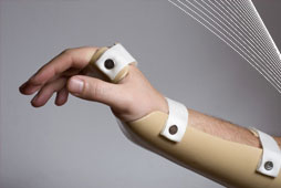 Patient's arm in a splint